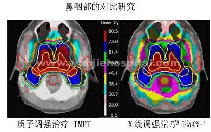 鼻咽癌质子治疗效果