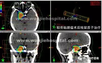 质子治疗脑膜瘤效果