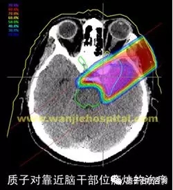 胶质瘤质子治疗效果