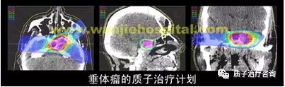 垂体瘤质子治疗效果
