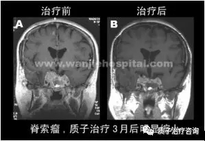 脊索瘤质子治疗前后对比