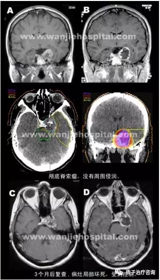 颅低脊索瘤质子治疗前后对比