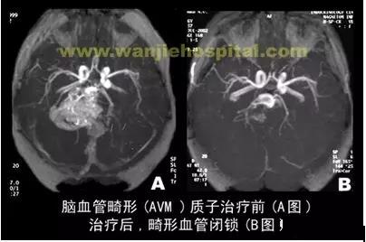 动静脉畸形(AVM)质子治疗效果