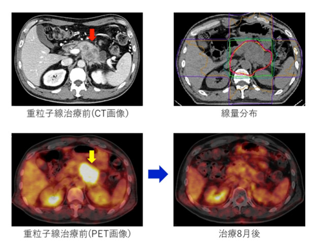 重离子治疗胰腺癌的效果