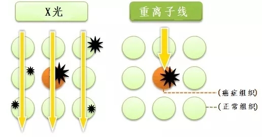 质子重离子治疗和X射线治疗对比图