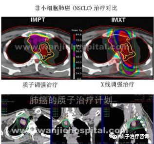 质子治疗肺癌效果