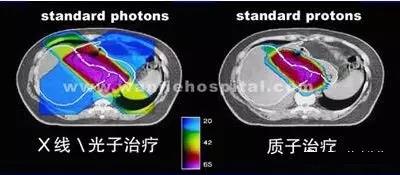 肝癌质子治疗效果