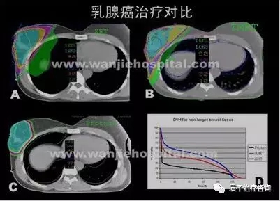 乳腺癌质子治疗效果