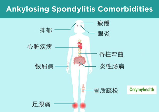 强直性脊柱炎常见症状有哪些