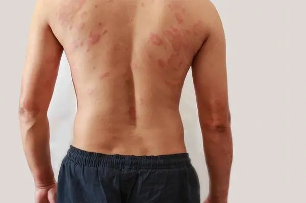 红斑狼疮是什么症状