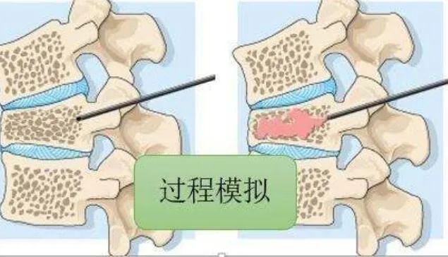 骨质疏松的过程模拟