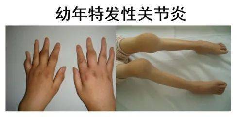 幼年特发性关节炎怎么治疗效果好