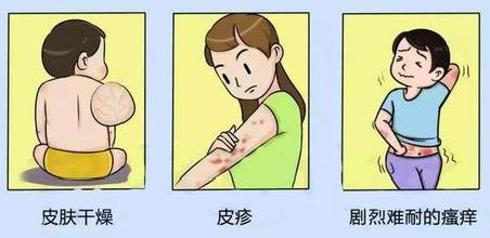 特应性皮炎有什么症状