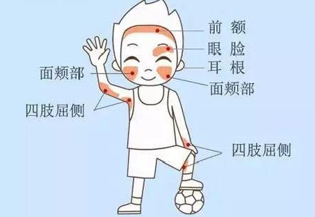 特应性皮炎诊断主要身体部位