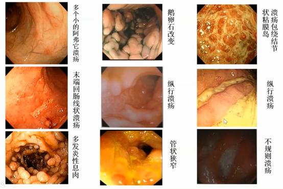 溃疡性结肠炎肠镜