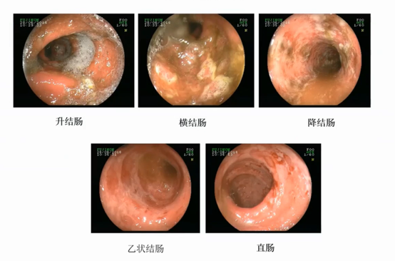 溃疡性结肠炎肠镜