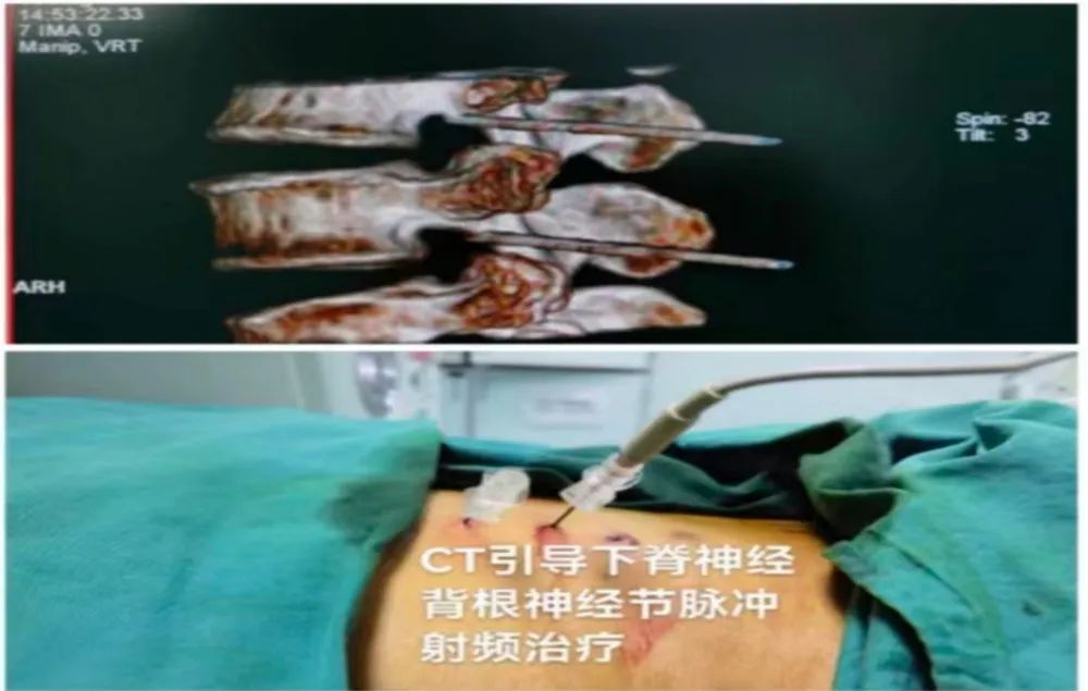 CT引导下脊神经背根神经节脉冲射频治疗带状疱疹后神经痛