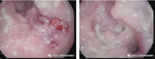 直肠乙状结肠大量纵形溃疡