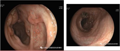 治疗一年后的乙状结肠溃疡