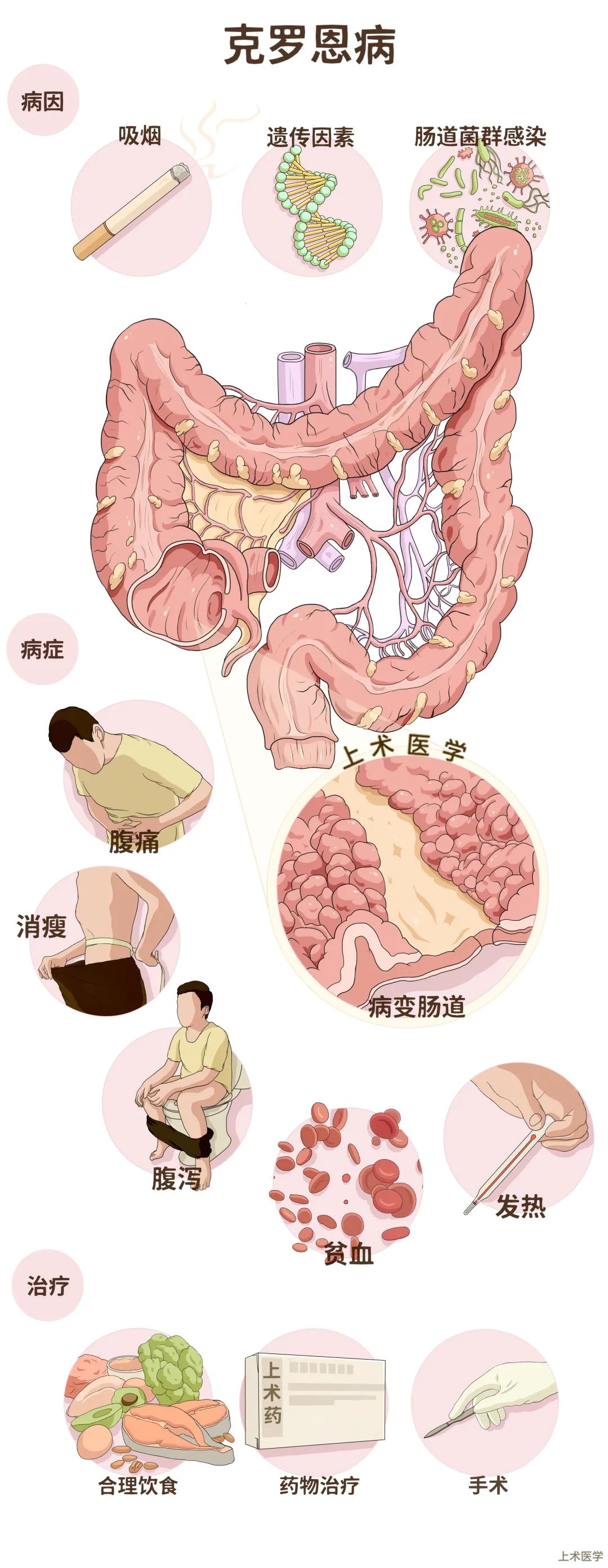 克罗恩病