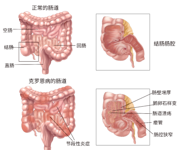 克罗恩病和正常肠道对比