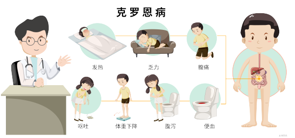 克罗恩病的表现