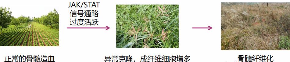 骨髓纤维化的过程