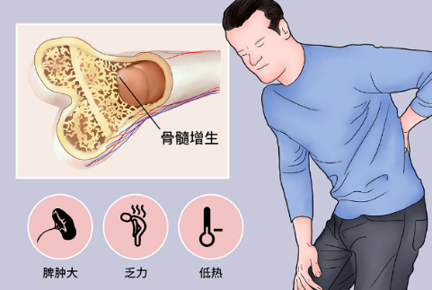 骨髓纤维化是什么意思,骨髓纤维化具体症状有哪些