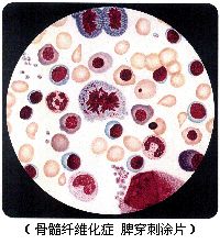 什么是骨纤维化,骨纤维化的症状和病因是什么、并发症有哪些