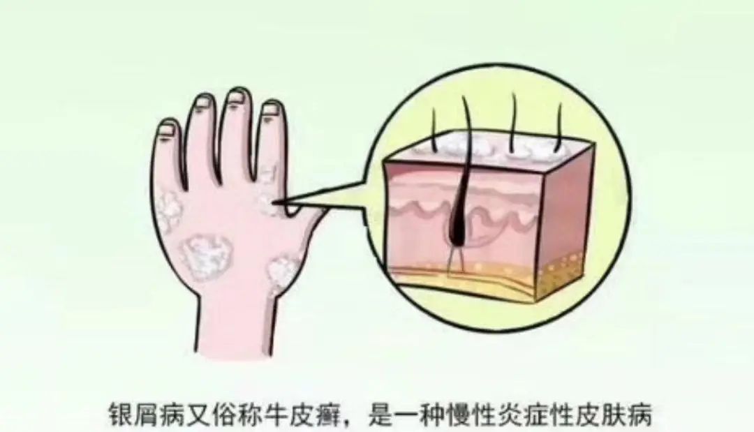 银屑病为什么晚上比早上严重