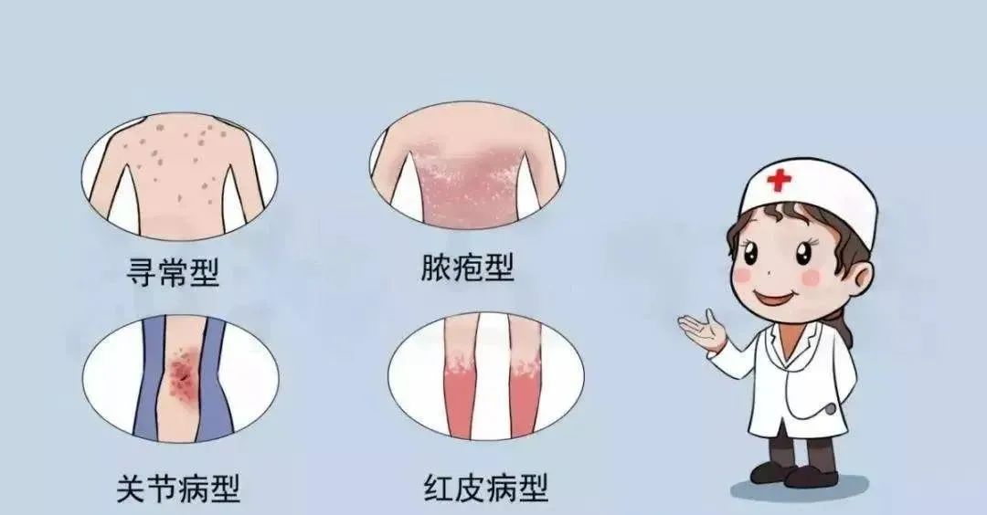 银屑病分几种类型
