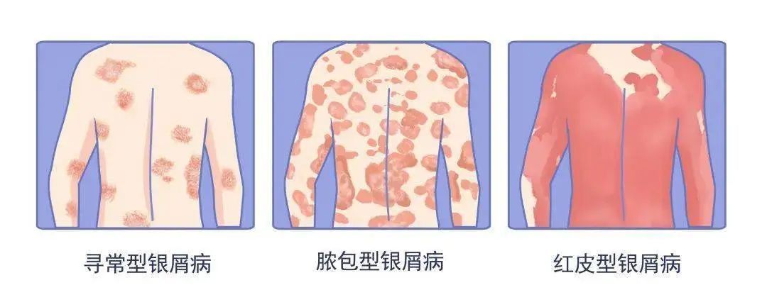银屑病初期症状图片,牛皮癣早期怎么控制、怎么护理