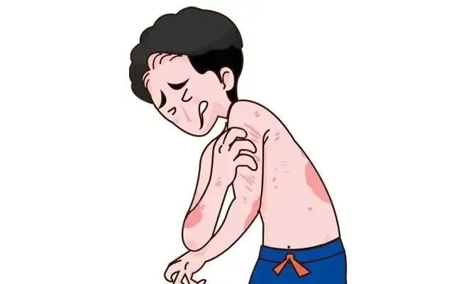 银屑病的原因是什么引起的、临床表现有哪些、如何治疗