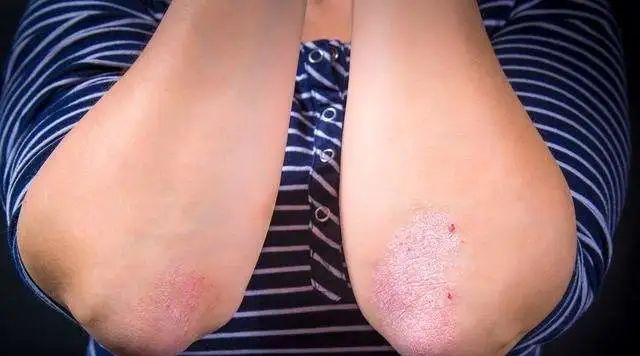 牛皮癣冬季注意事项