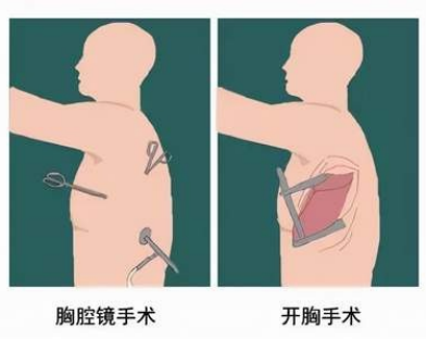 肺癌手术是怎么做的,肺癌手术流程详解
