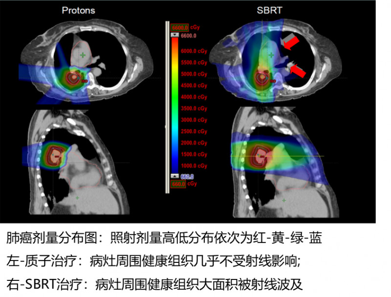 肺癌质子治疗和传统放疗对比