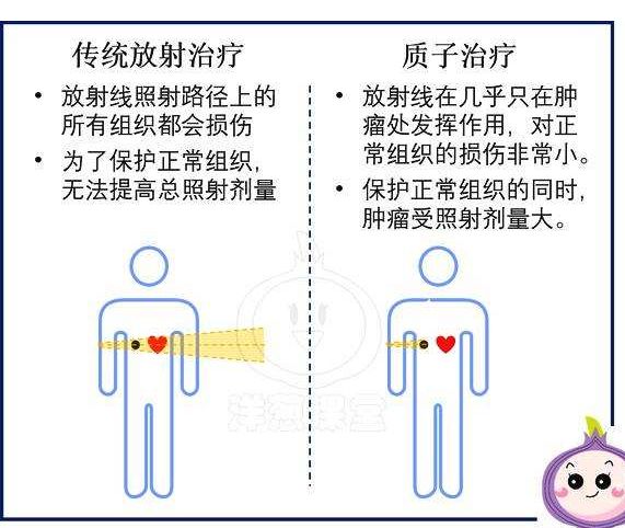 胃癌质子重离子治疗效果好吗